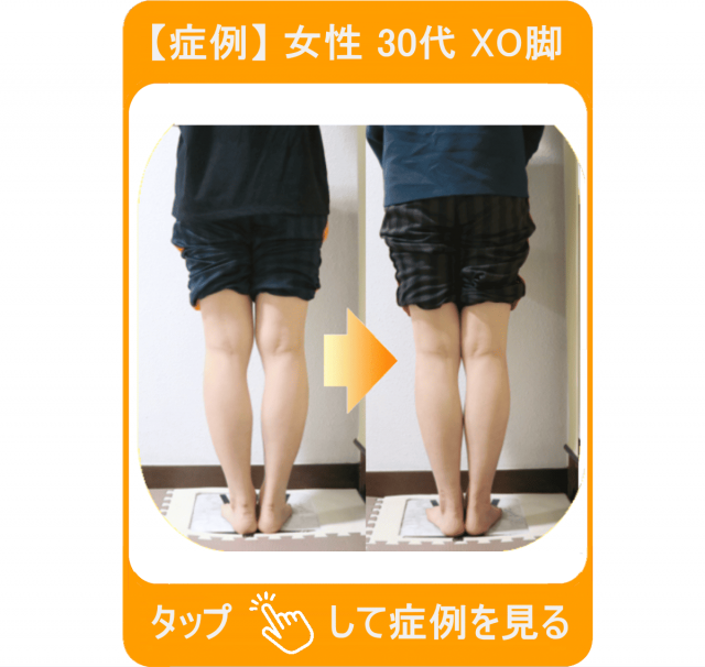 【症例】女性 30代 XO脚