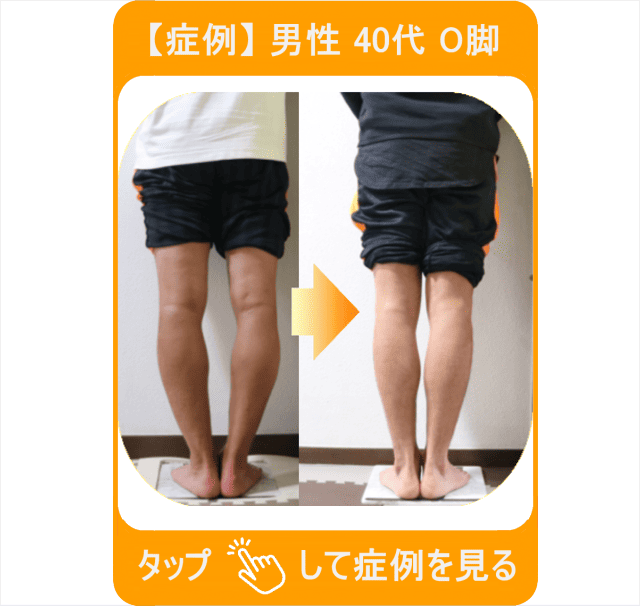 【症例】男性 40代 O脚　タップして症例を見る