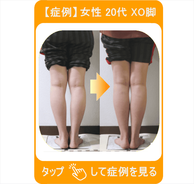【症例】女性 20代 XO脚