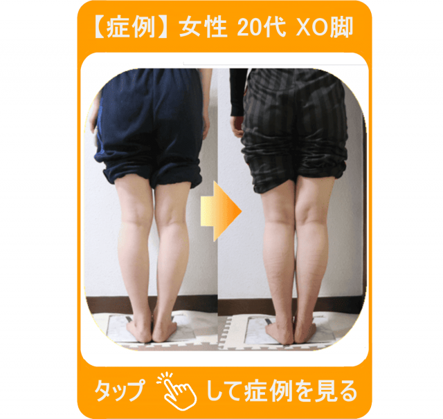 【症例】女性 20代 XO脚