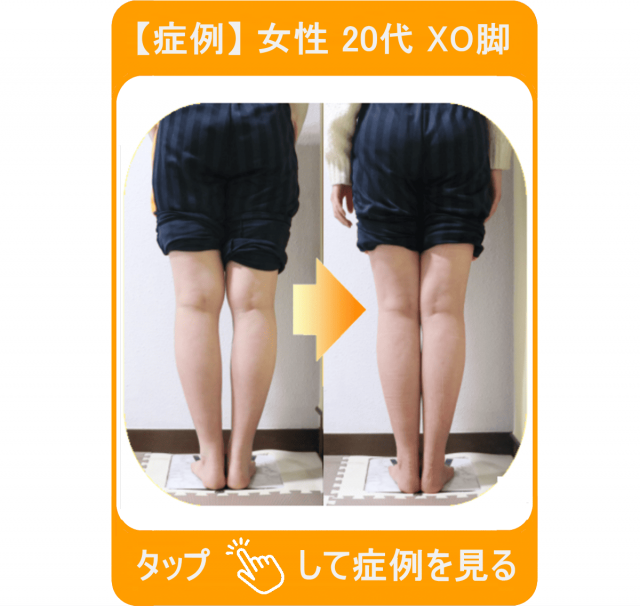 【症例】女性 20代 XO脚