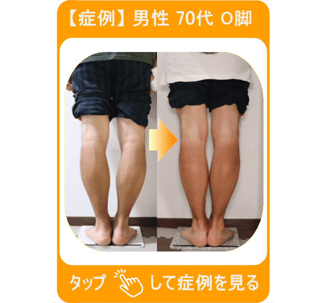 【症例】男性 70代 O脚