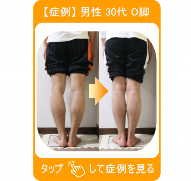 【症例】男性 30代 O脚　タップして症例を見る