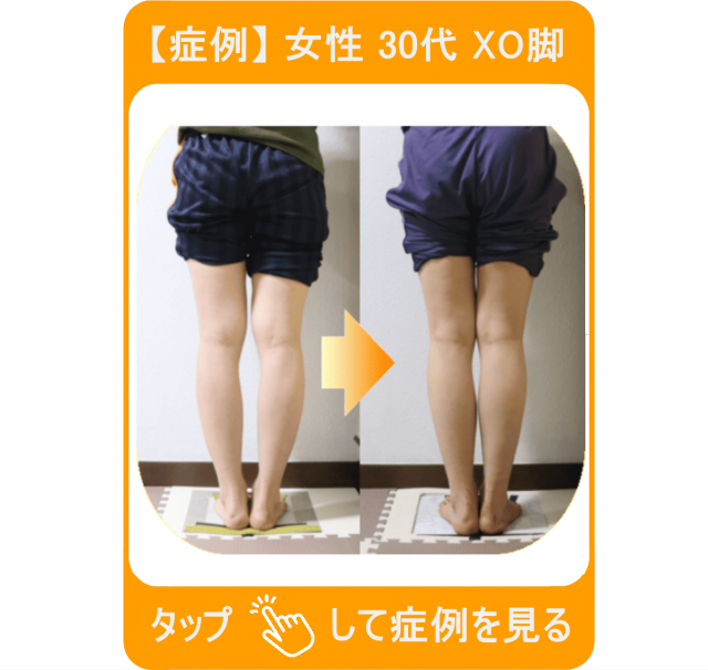 【症例】女性 30代 XO脚