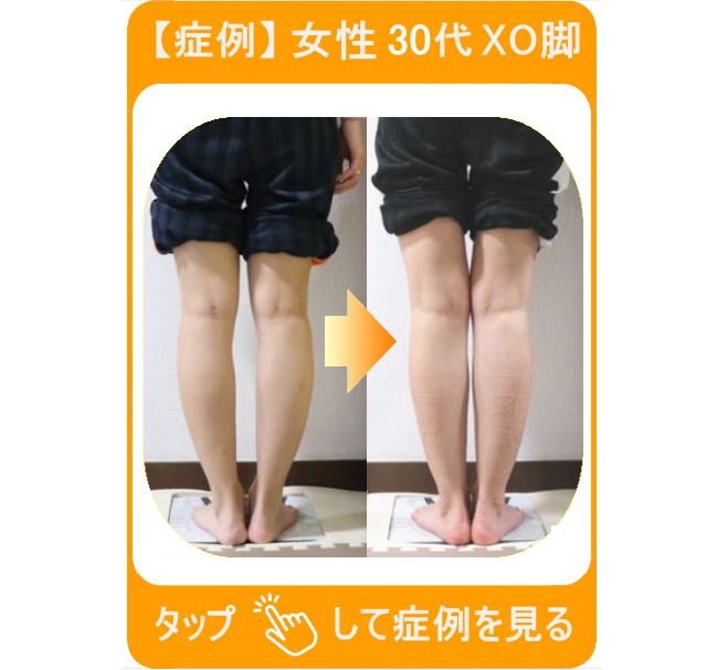 【症例】女性 30代 XO脚