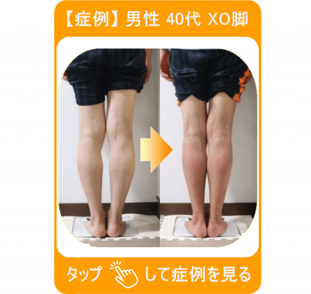 【症例】男性 40代 XO脚