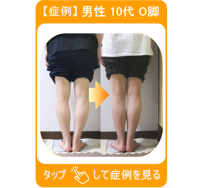 【症例】男性 70代 O脚