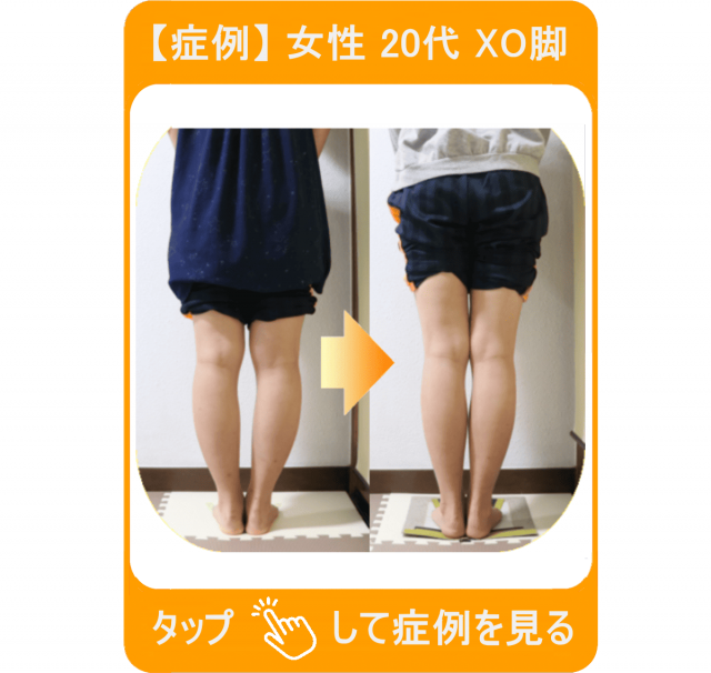 【症例】女性 20代 XO脚