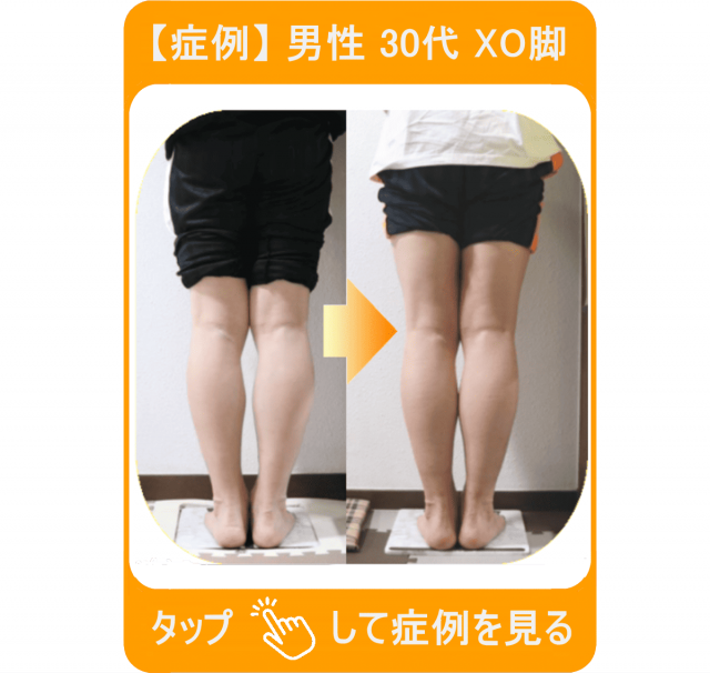 【症例】男性 30代 XO脚　タップして症例を見る