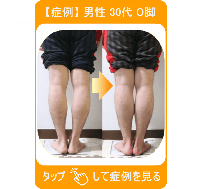 【症例】男性 30代 O脚　タップして症例を見る